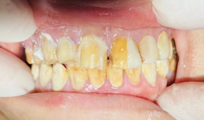 Before