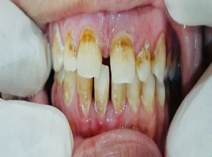 Before