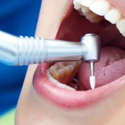 root-canal-treatment-img-1